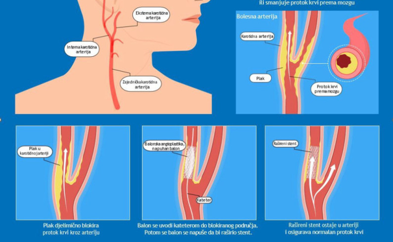 Preventivni pregledi krvnih sudova u nedjelju u UB Foča